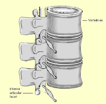 In spinal stenosis, the spinal canal, which contains and protects the spinal cord and nerve roots, narrows and pinches the spinal cord and nerves.