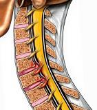 Disk Herniation...