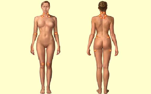 Tender points are specific sites on the body that cause pain when pressed. The pain may spread when a tender point is pressed and cause pain in a larger area (for example, down the leg, arm, or back).