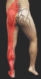 Sciatica...