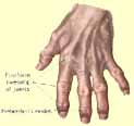 arthritis...